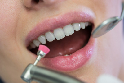 Limpieza Dental